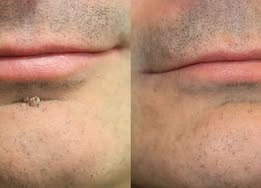 🧑‍⚕️PuraCure® 2-in-1 Microneedle & Hydrocolloid Patch🍀| Removes Raised Moles, Acne, Flat Warts & Skin Tags | Helps Improve Wrinkles, Scars & Blemishes | Invisible Patches for Face & Body
