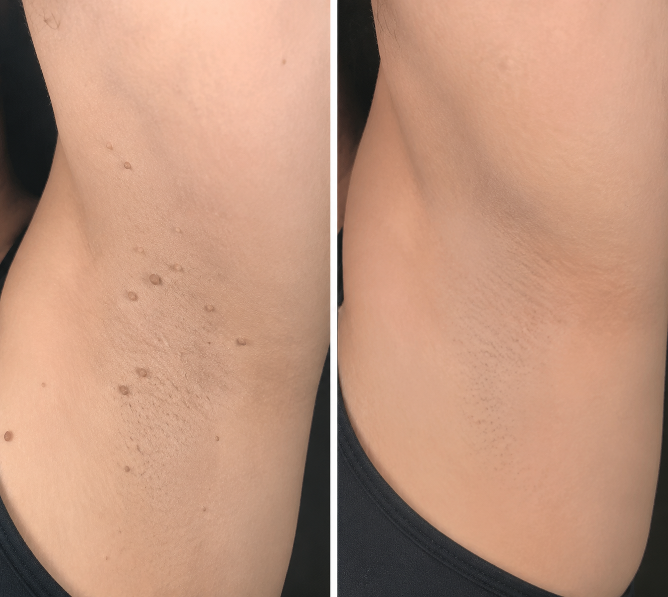 🧑‍⚕️PuraCure® 2-in-1 Microneedle & Hydrocolloid Patch🍀| Removes Raised Moles, Acne, Flat Warts & Skin Tags | Helps Improve Wrinkles, Scars & Blemishes | Invisible Patches for Face & Body