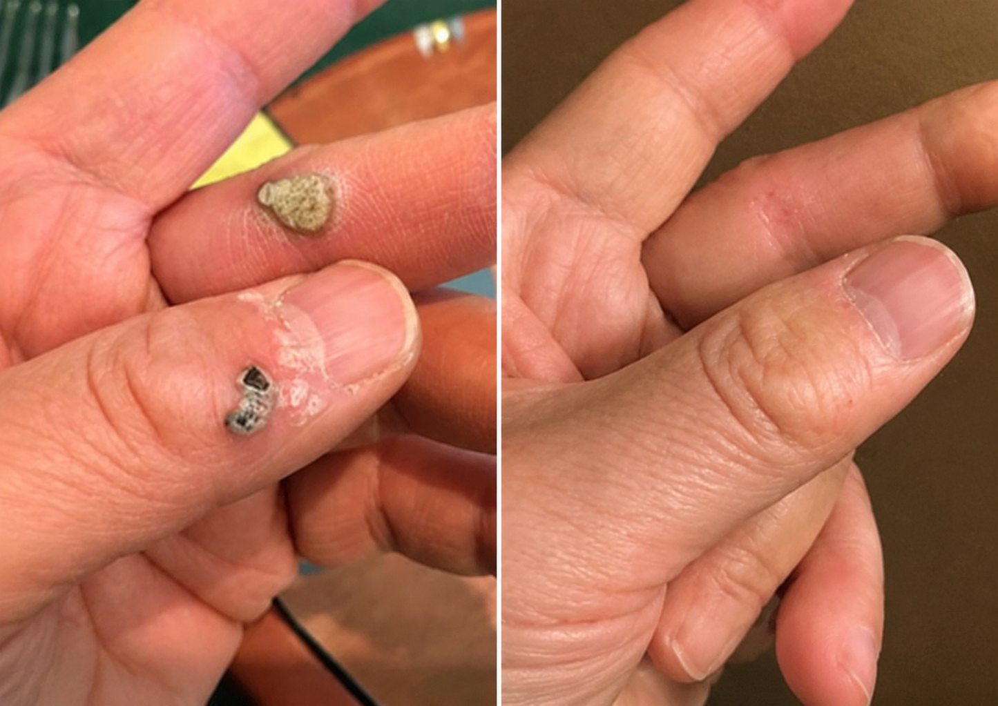 🧑‍⚕️PuraCure® 2-in-1 Microneedle & Hydrocolloid Patch🍀| Removes Raised Moles, Acne, Flat Warts & Skin Tags | Helps Improve Wrinkles, Scars & Blemishes | Invisible Patches for Face & Body