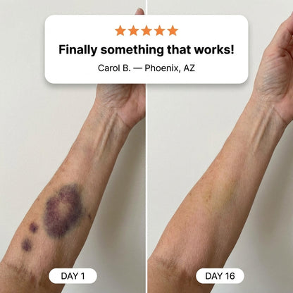 💥75K+ SOLD -✨PuraCure® Bruise Repair & Skin-Strengthening Cream